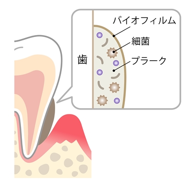 歯に付くバイオフィルム
